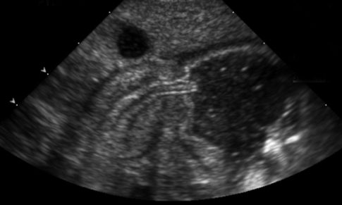 Congenital Hypertrophic Pyloric Stenosis (CHPS)