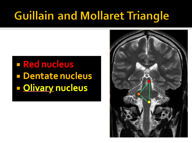 Hypertrophic olivary degeneration (1)