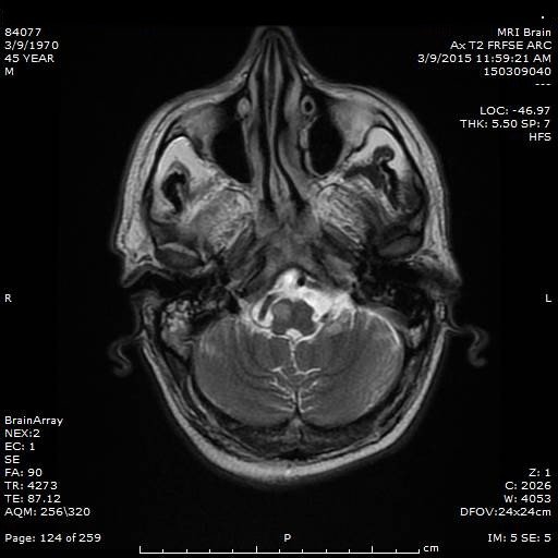Hypertrophic olivary degeneration (2)