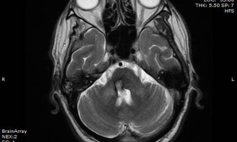 Hypertrophic Olivary Degeneration