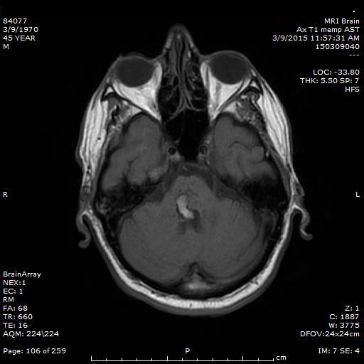 Hypertrophic olivary degeneration (4)