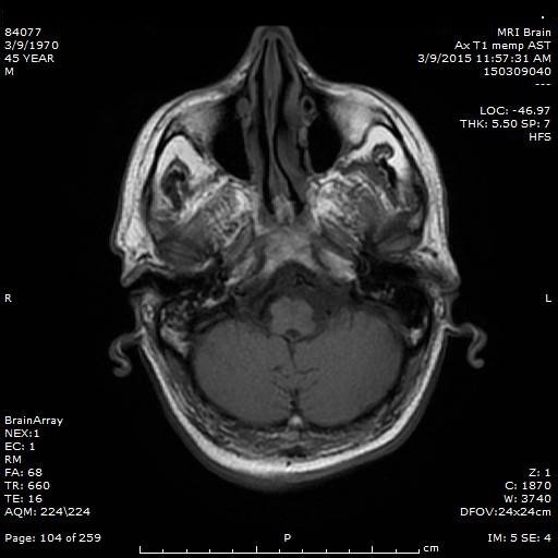 Hypertrophic olivary degeneration (5)