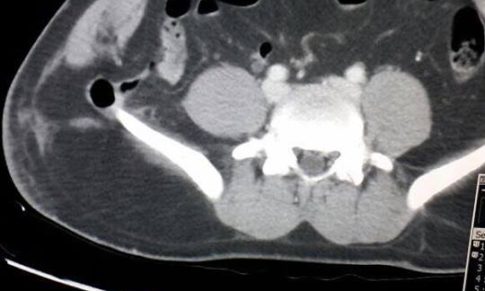 Traumatic Right Inferior Lumbar Hernia
