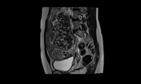 Uterine Diffuse Leiomyomatosis