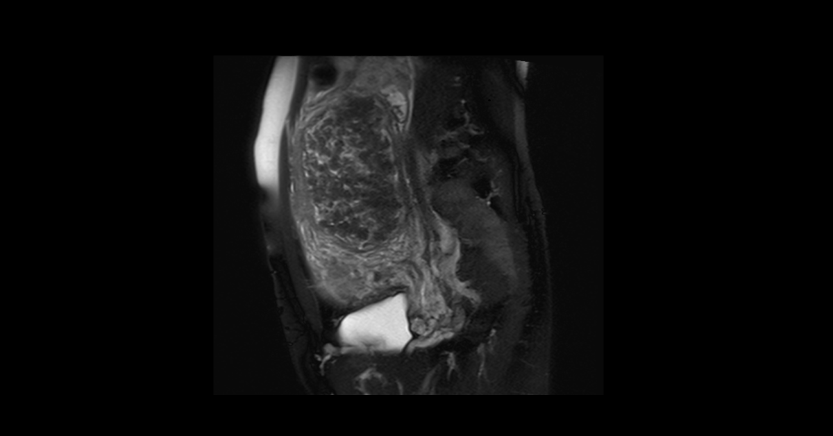 03_Uterine Diffuse Leiomyomatosis (2)