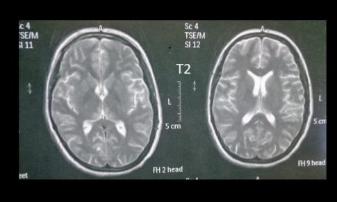 Wernicke-Korsakoff’s Encephalopathy (Thiamine Deficiency)
