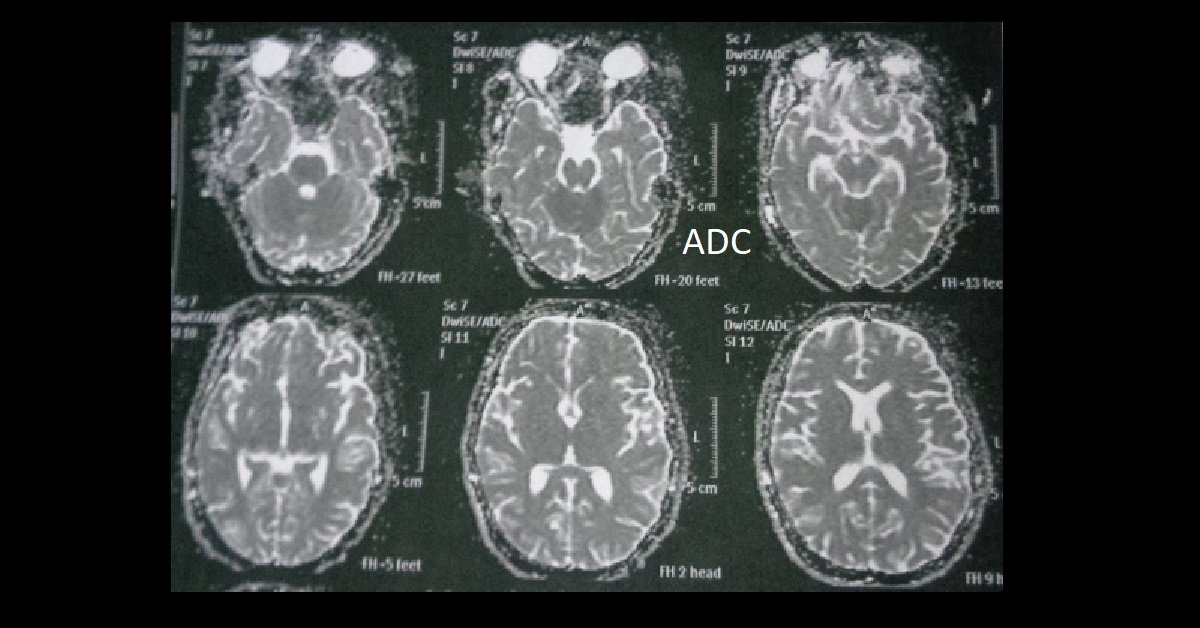 04_Wernicke-encephalopathy (4 ADC)