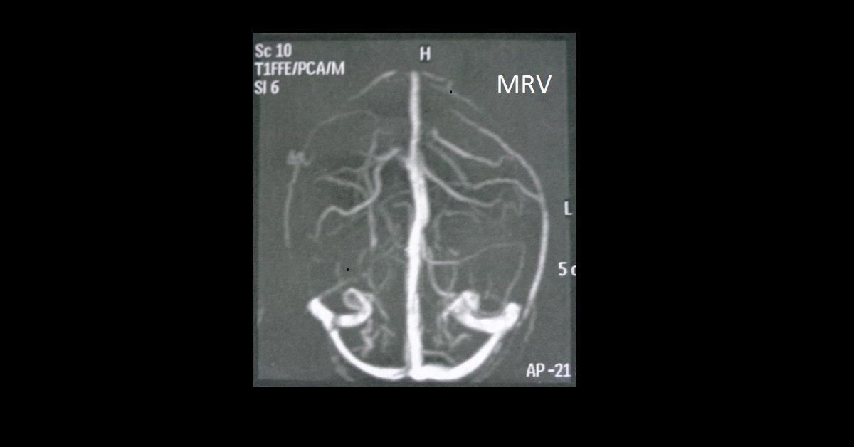 04_Wernicke-encephalopathy (5 MRV)