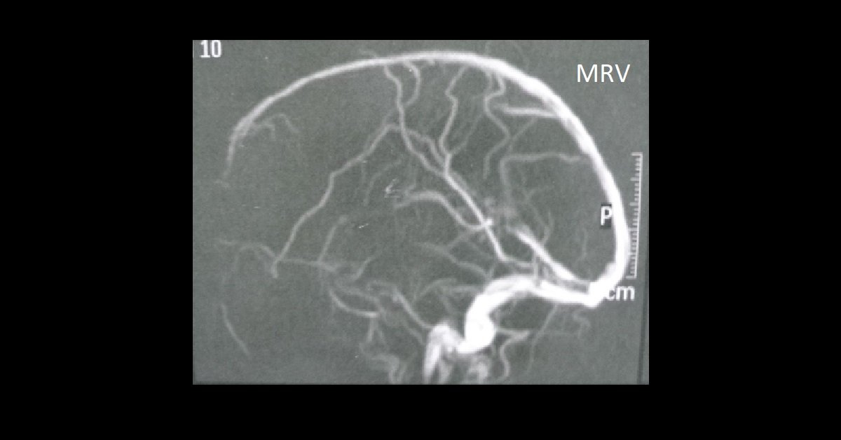 04_Wernicke-encephalopathy (6 MRV)