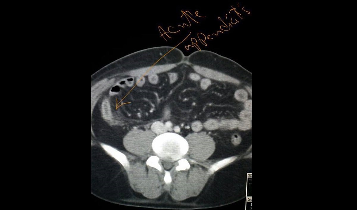 Acute appendicitis (1)