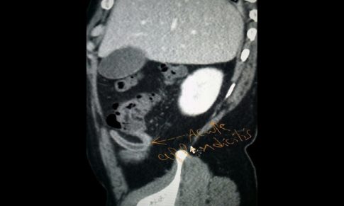 Acute Appendicitis Complicated By (SMV) Thrombosis