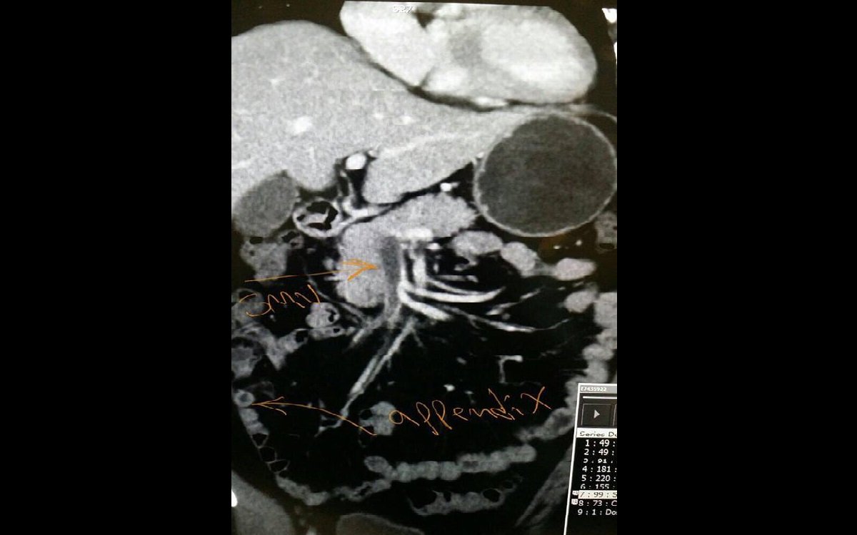 Acute appendicitis (3)