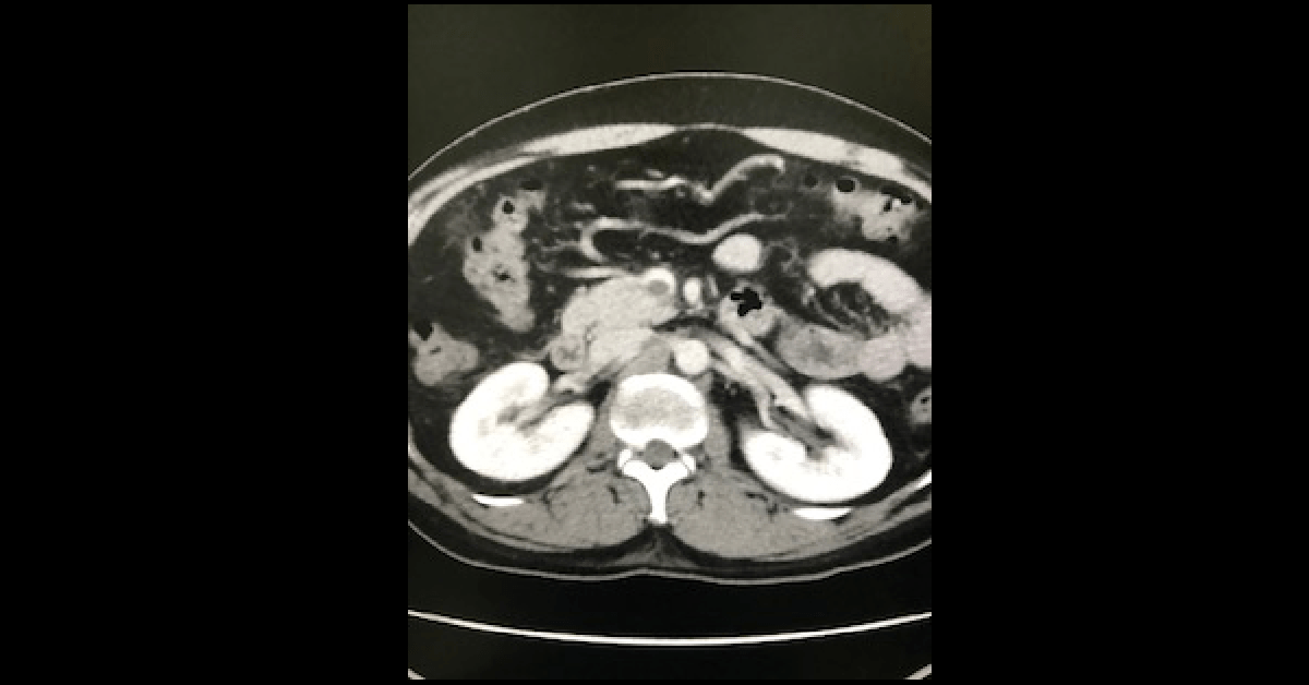 Acute appendicitis (4)