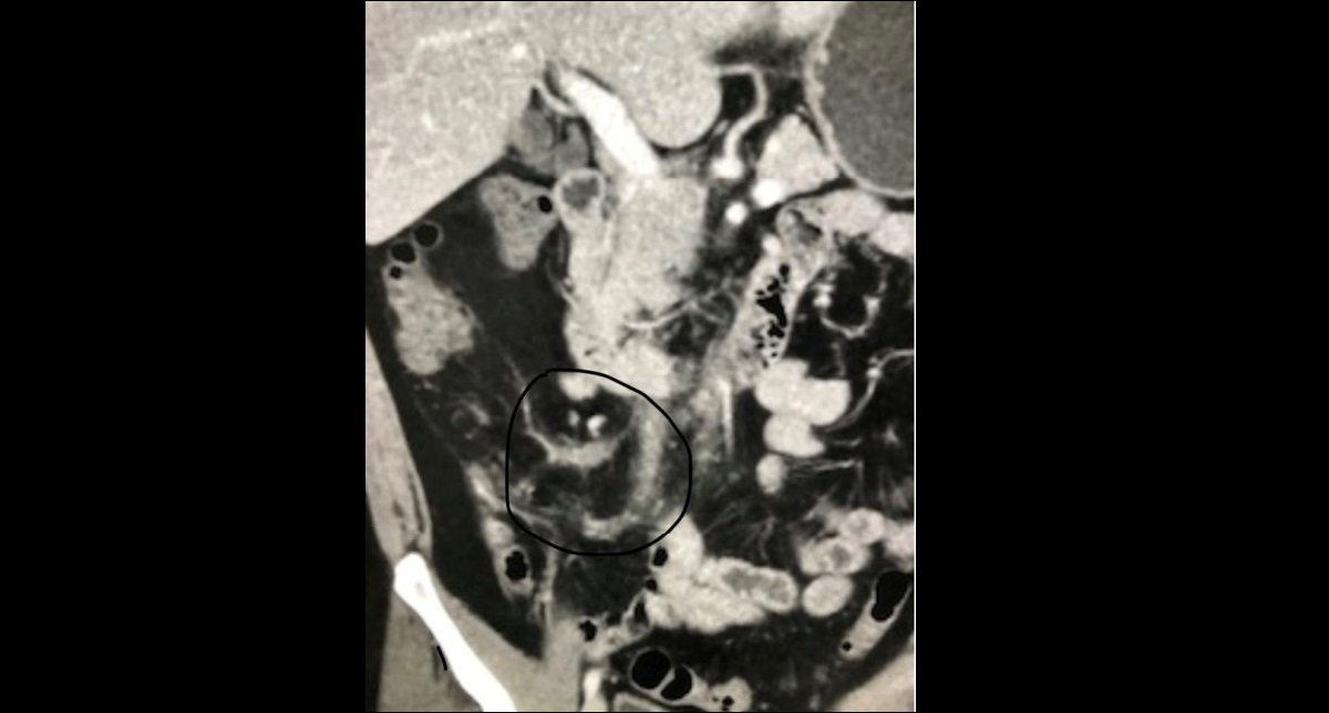 Acute appendicitis (5)