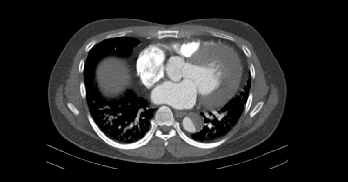 Aortic Dissection (1)