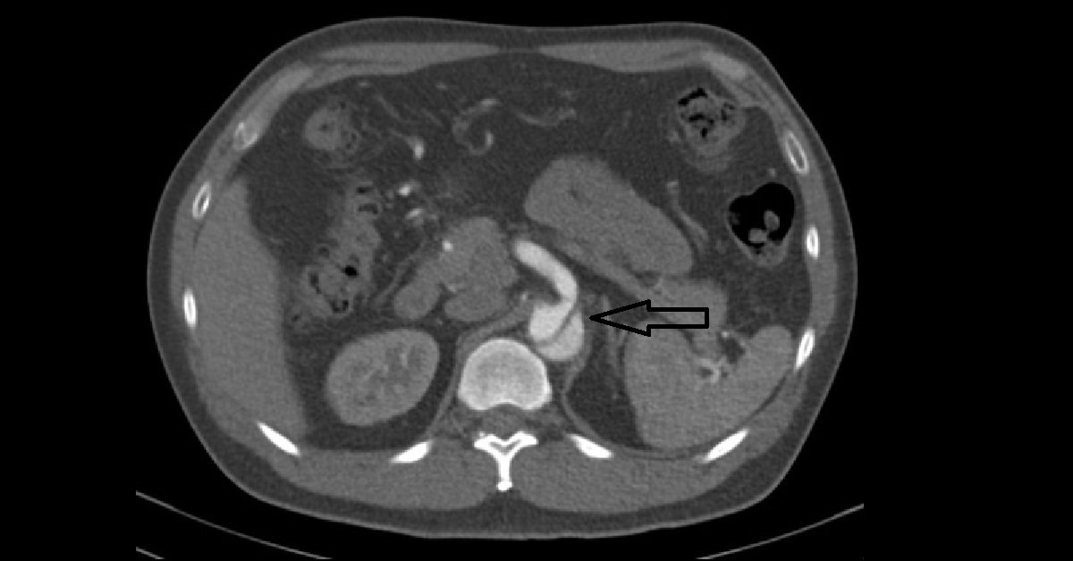 Aortic Dissection (2)