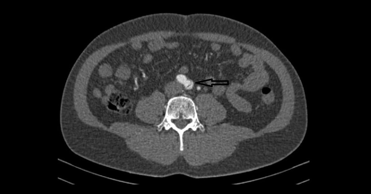 Aortic Dissection (3)