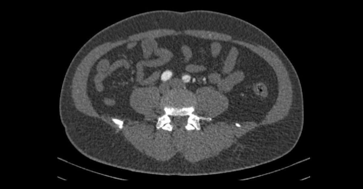 Aortic Dissection (4)