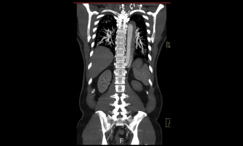 Aortic Dissection