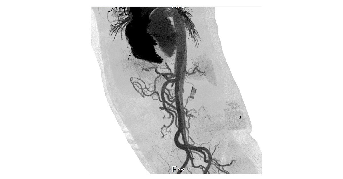 Aortic Dissection (6)