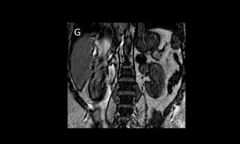 Left Adrenal Adenoma (Lipid rich)