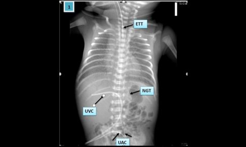 Mal-positioned Tubes In Pediatric