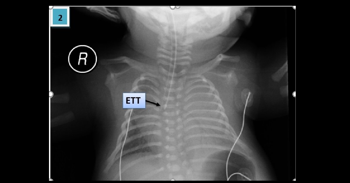 Mal-positioned Tubes In Pediatric (2)