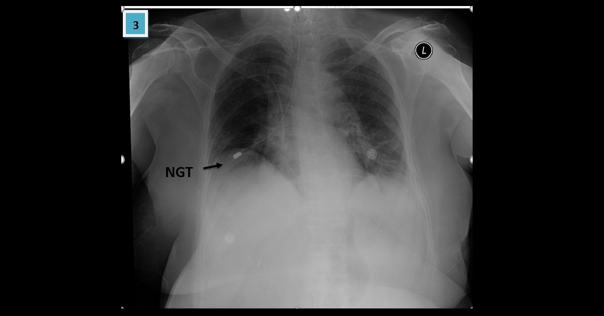 Mal-positioned Tubes In Pediatric (3)