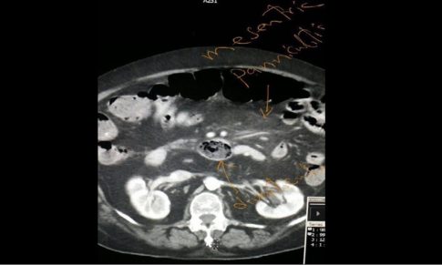 Mesenteric Panniculitis