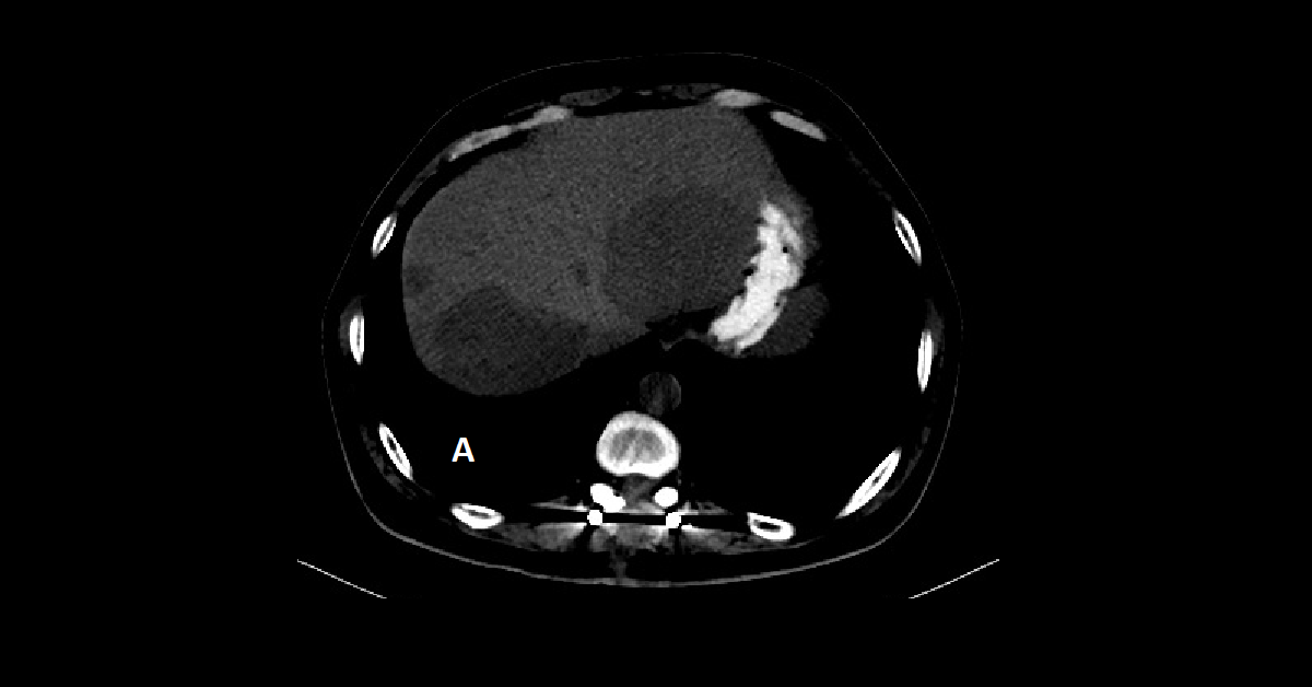 Multiple hepatic hemangiomas (1)