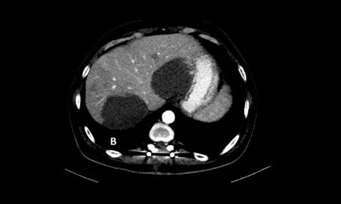 Multiple Hepatic Hemangiomas