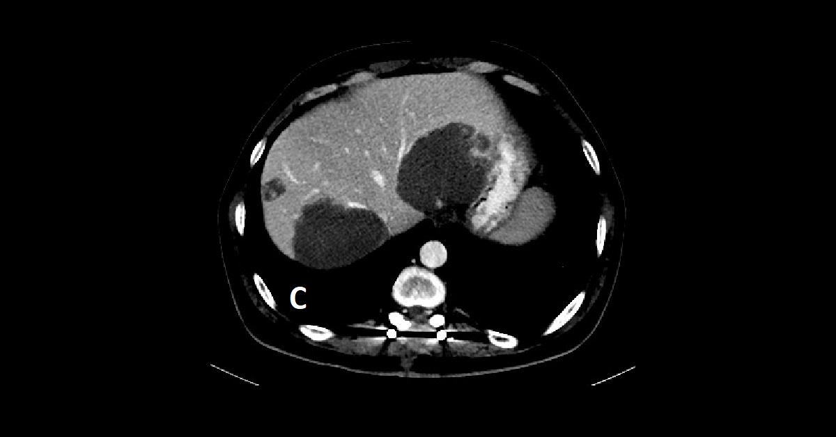 Multiple hepatic hemangiomas (3)