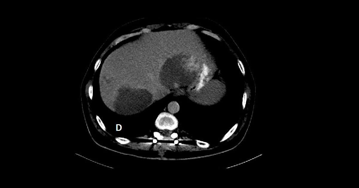 Multiple hepatic hemangiomas (4)