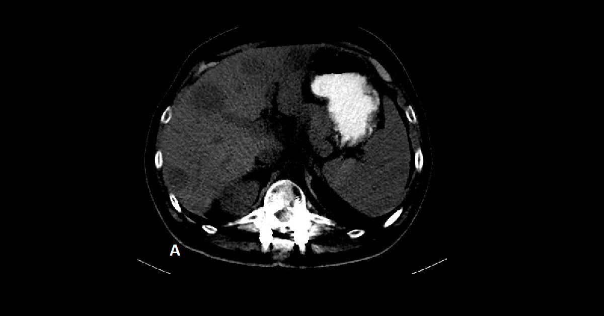 Multiple hepatic hemangiomas (5)