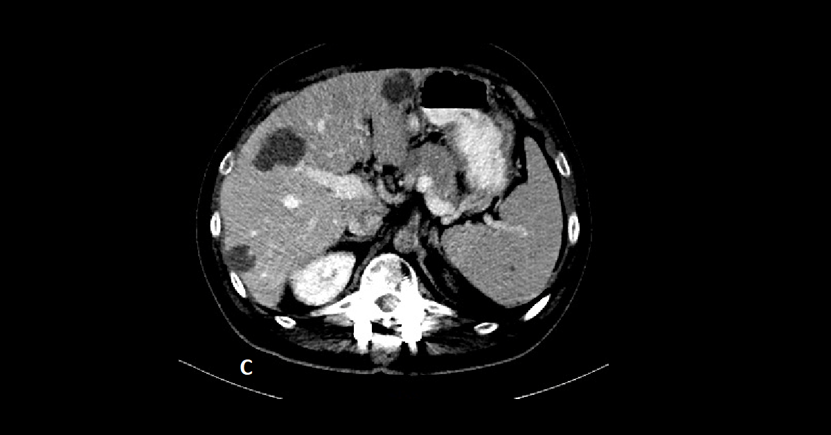 Multiple hepatic hemangiomas (7)