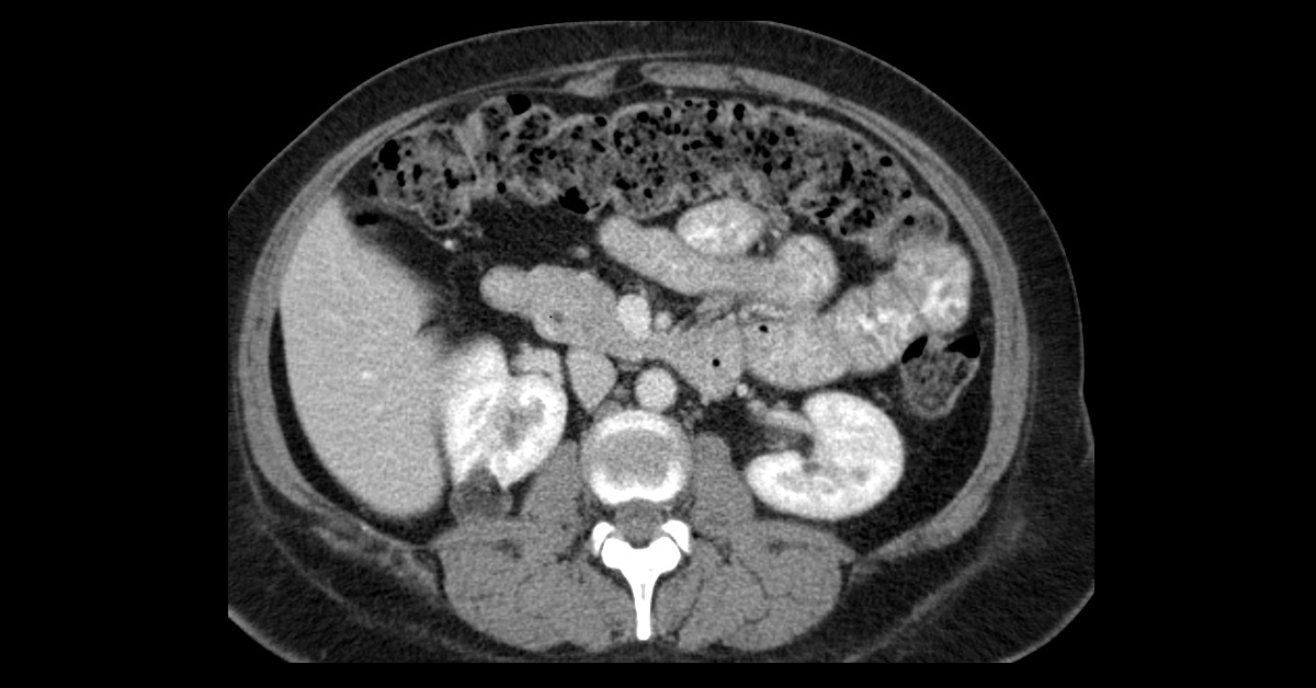 Renal Angiomyolipoma - Manal's Classroom