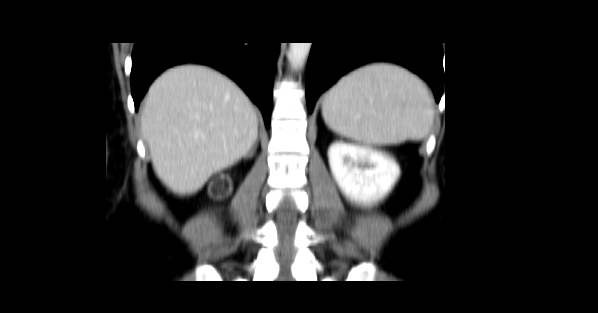 Renal angiomyolipoma (3)