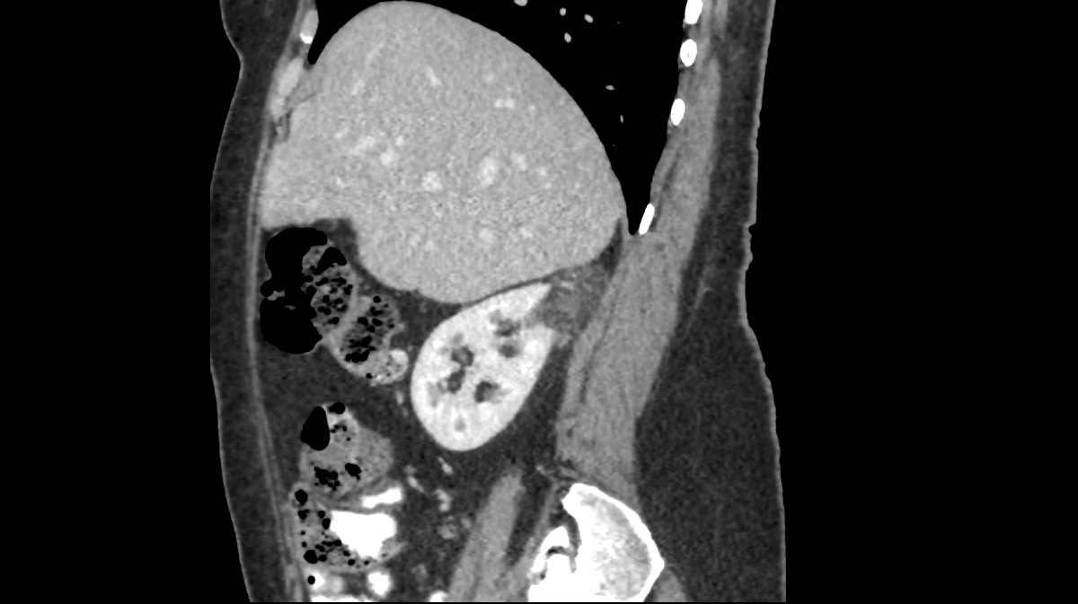 Renal angiomyolipoma (5)