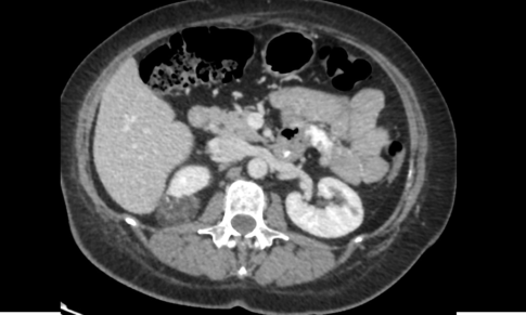 Renal Angiomyolipoma