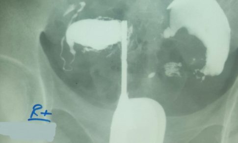 Uterus Didelphys