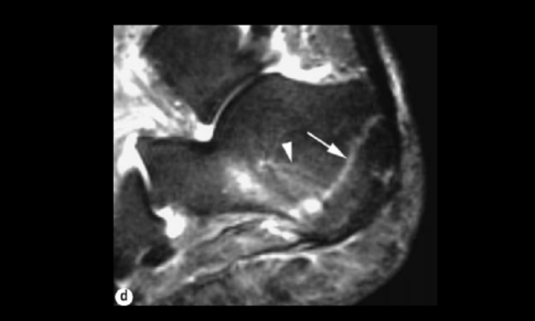 Stress Fracture