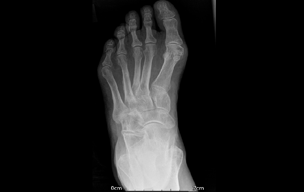 stress fracture (4)