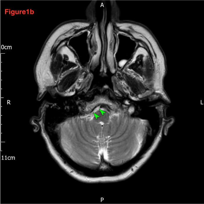 Left ICA spontaneous acute dissection 1b