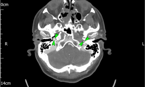 Right Vertebral & Left Internal Carotid Arteries Spontaneous Acute Dissection