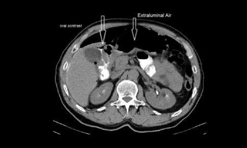 Perforated Duodenal Ulcer
