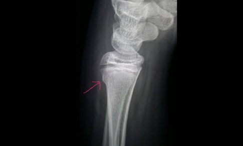 Torus Fracture