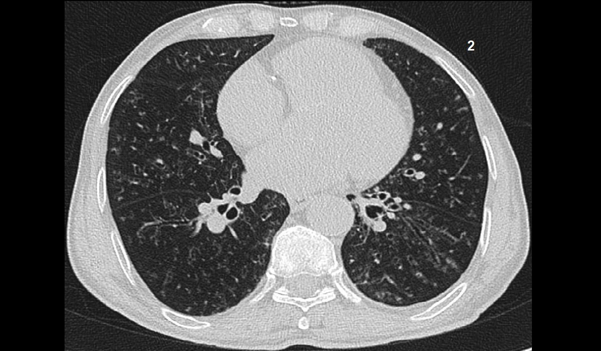 allergic bronchopulmonary aspergillosis 2