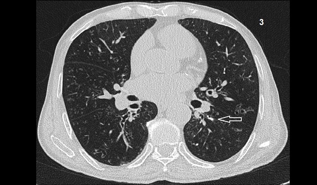 allergic bronchopulmonary aspergillosis 3