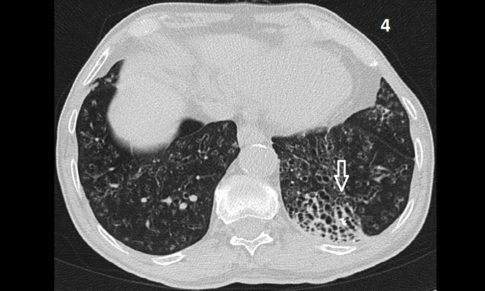 Allergic Bronchopulmonary Aspergillosis