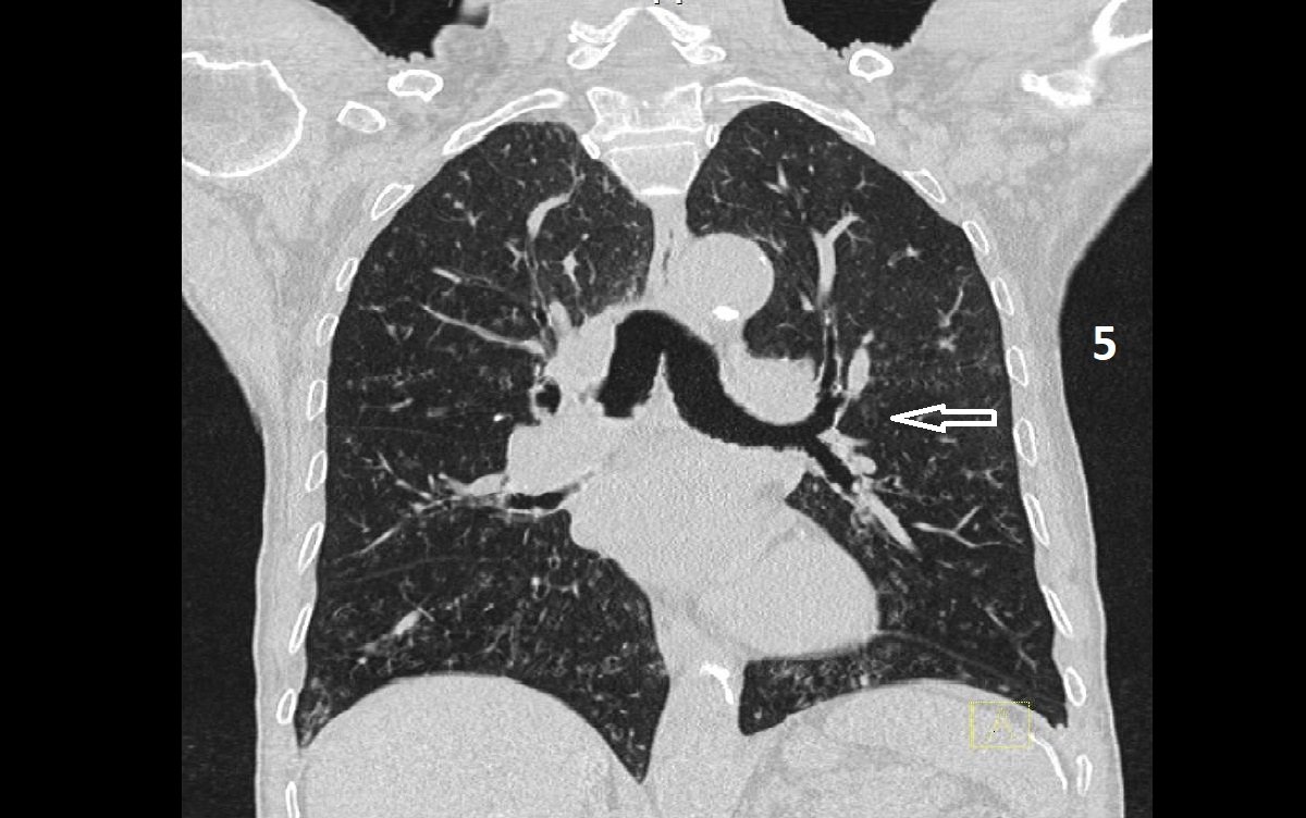allergic bronchopulmonary aspergillosis 5